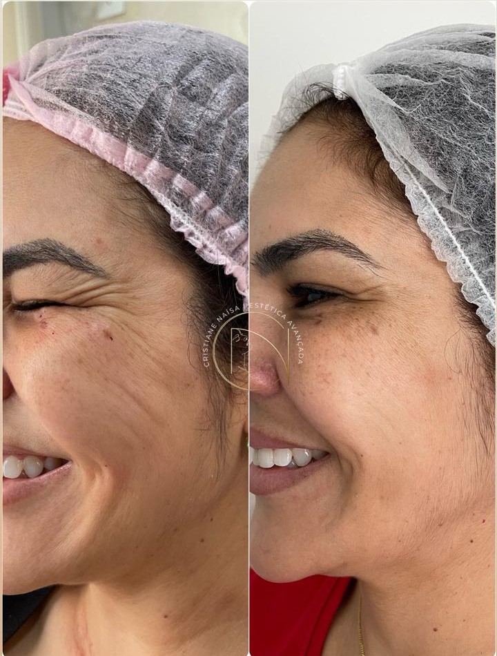 Bioestimuladores de Colágeno Facial e Corporal